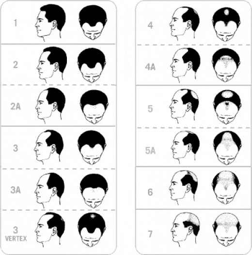 The Norwood Scale of Hair Loss