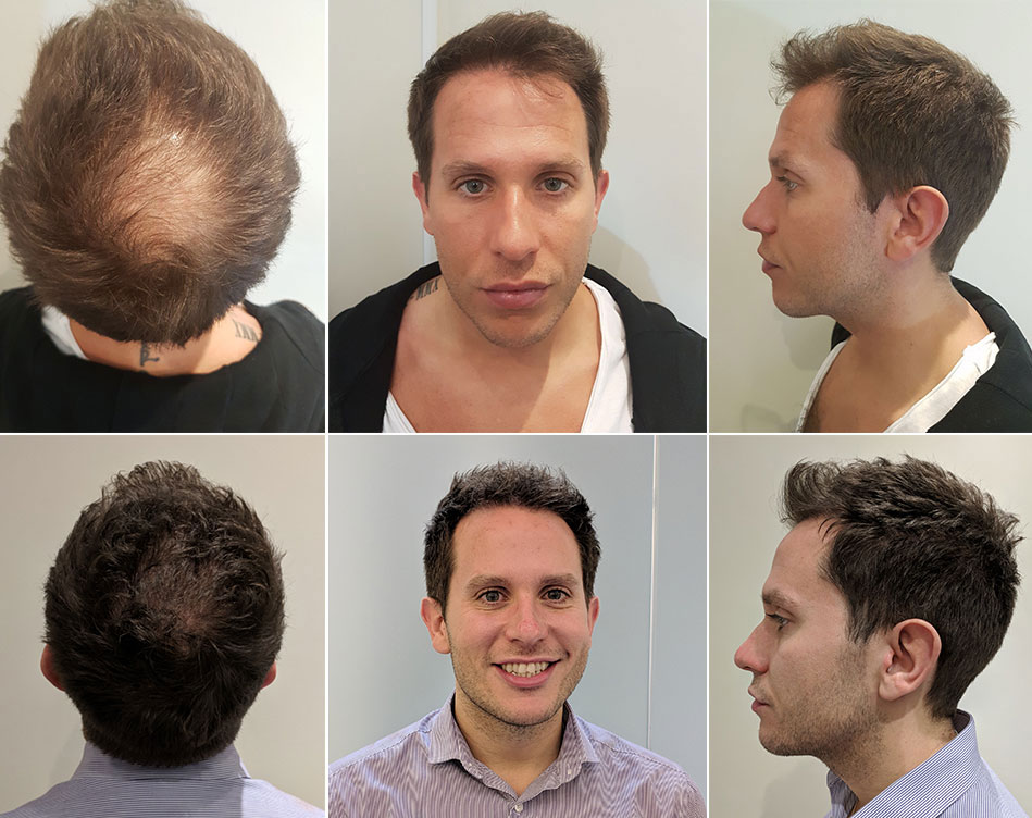 Hair Transplant Before and After - wide 7