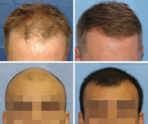 hair transplant before and after crown temple area photos