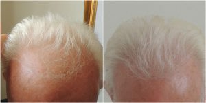 hair-transplant-before-after-the-private-clinic-web