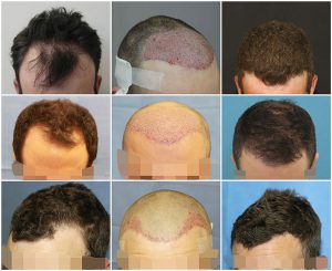 FUE Hair Transplant before after photos UK