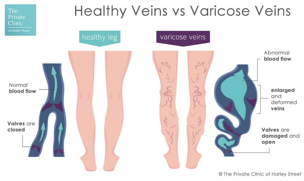Varicose veins vs normal healthy veins