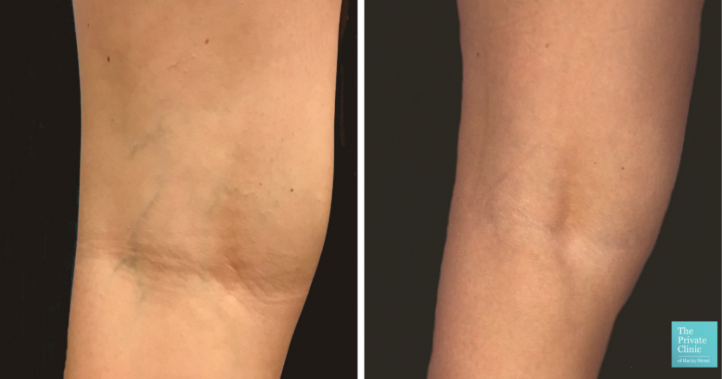 leg thread veins before and after photo
