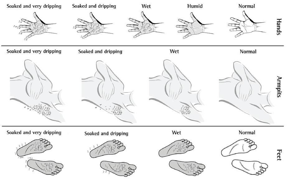 Hyperhidrosis Hyperhidrosis