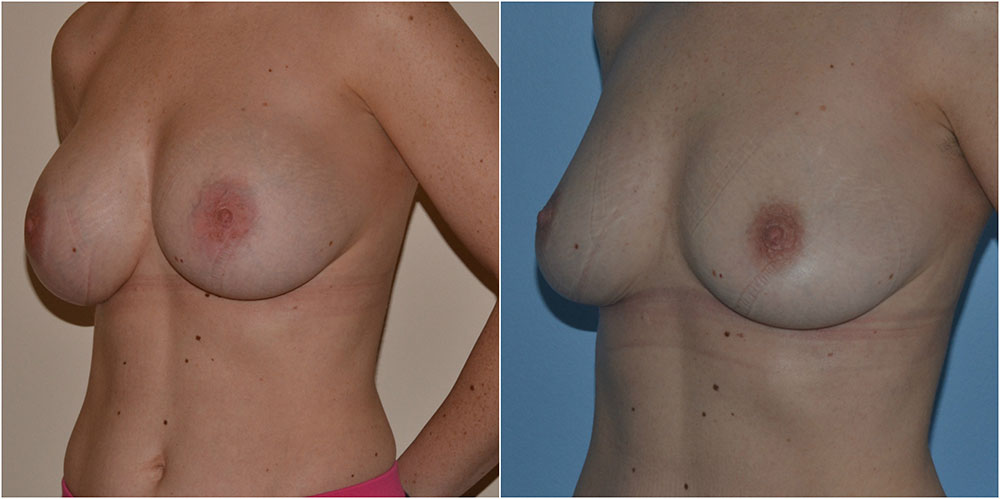 implant-removal-before-after-adrian-richards-the-private-clinic-web