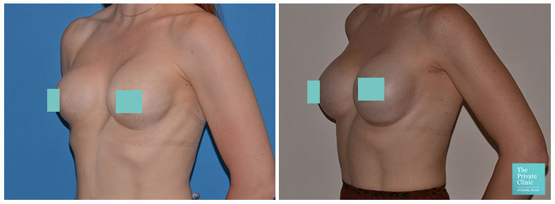 breast implant replacement before and after photo