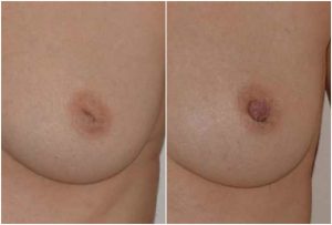 inverted-nipple-before-after-adrian-richards-aurora-clinics-part-of-the-private-clinic