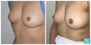 inverted nipple correction before after photos results