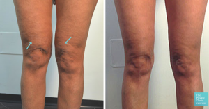 knee liposuction before after photo