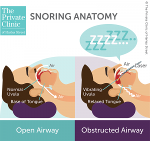 laser assisted uvulopalatoplasty LAUP surgery stop snoring