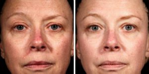 laser resurfacing treatment before after photo