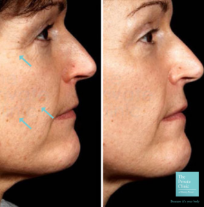 laser skin resurfacing before and after photo