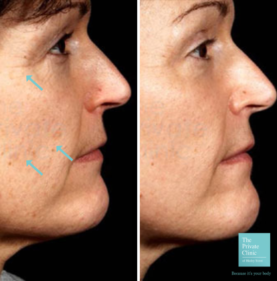 Skin Resurfacing Treatments