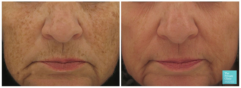 laser skin resurfacing pearl fusion before after photos