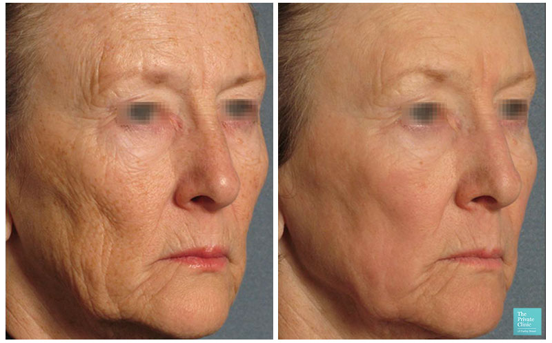 Best Non Surgical Anti Aging Treatments 19 Top 6 Wrinkle Treatment Uk