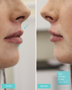 Before and after lip augmentation photo