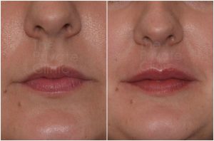 lip-filler-before-after-2-mel-the-private-clinic-web