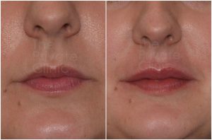 lip-filler-before-after-2-mel-the-private-clinic-web