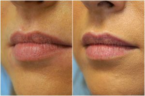 lip-filler-before-after-blog-mel-the-private-clinic-web