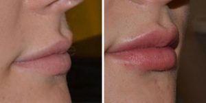 Before and After Lip Fillers with The Private Clinic