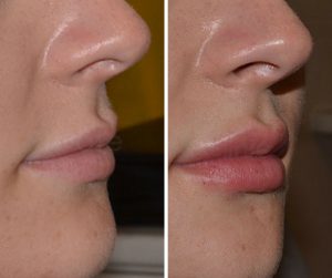 lip filler injections before after UK