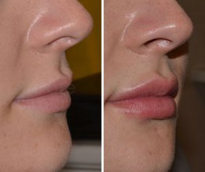 lip filler injections before after UK