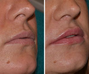 lip fillers before and after photo