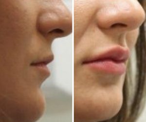 lip fillers before and after uk