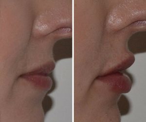 lip fillers results before after photo