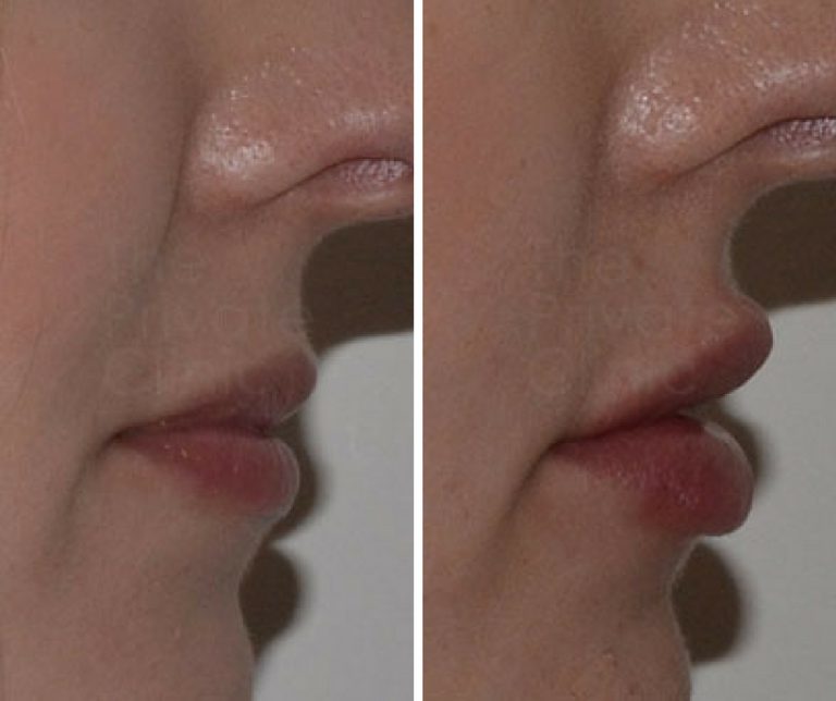 Lip fillers before and after UK, Lip Fillers Cost, Lip fillers Free Consultation
