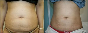 vaser liposuction stomach female before after photo