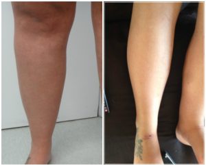 MicroLipo treatment for Lipoedema before and after photo