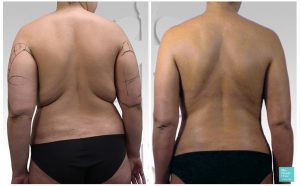 liposuction back bra fat arms before after photo