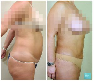 lipo stomach abdomen before after photo results