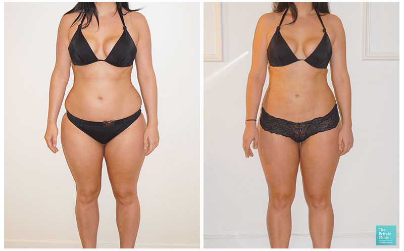 VASER 4D Hi-Def Lipo of the Flank - Liposuction of the Flanks