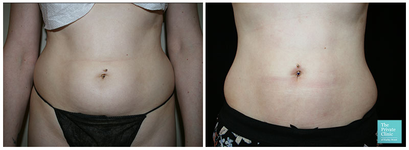 Stomach Liposuction London, Tummy Lipo UK