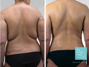 traditional liposuction surgery before and after photo