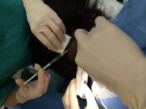 live-eyebrow-fue-hair-transplant