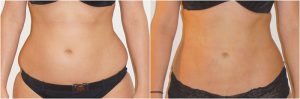 love handles muffin top flanks before after photo vaser liposuction