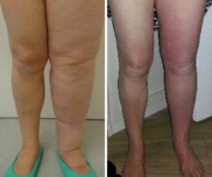 lymphoedema micro lipo before and after photo