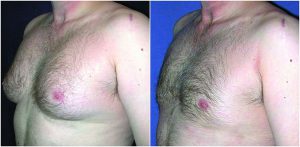 male chest reduction before after photo