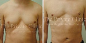 male chest reduction before and after