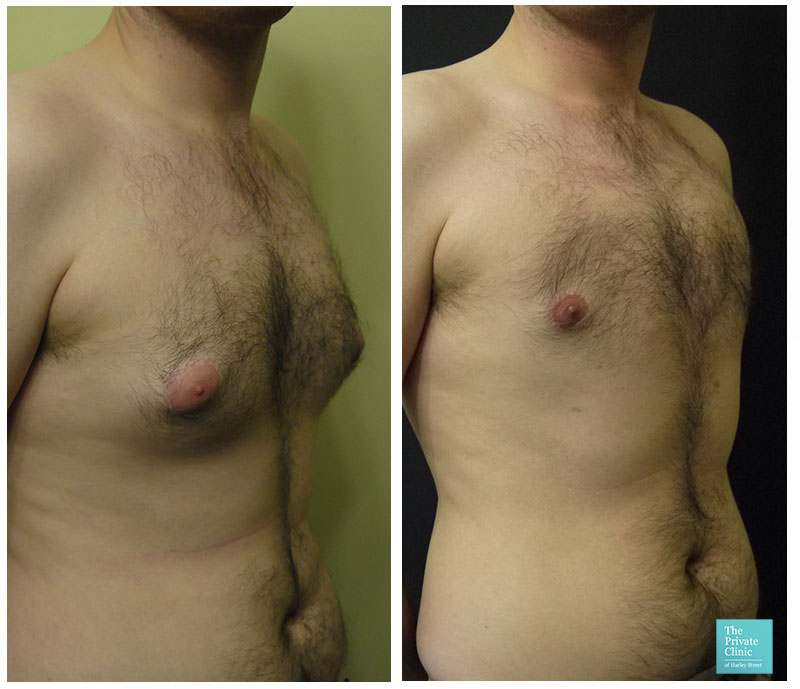 Best Pills to Get Rid of Man Boobs: Gynecomastia Supplements to Lose Man  Breasts 2024