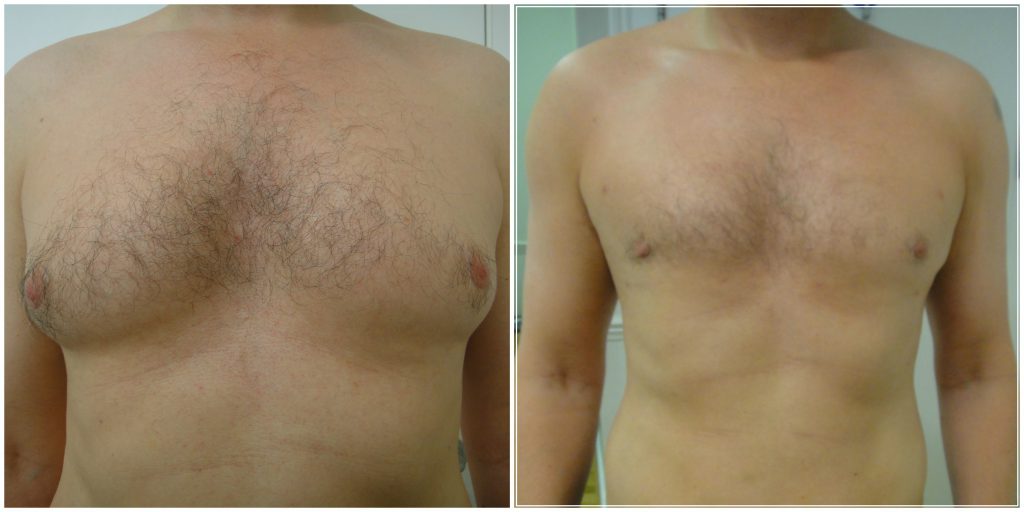 Before and after MicroLipo Male Chest Reduction at The Private Clinic with Dr Gupta.