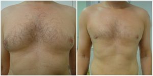 male breast reduction before after photo