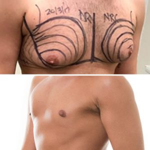 male chest reduction before after photo