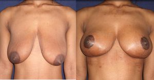 mastopexy-before-and-after