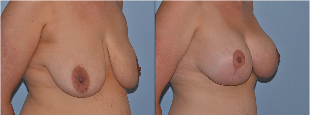 breast uplift before after photos