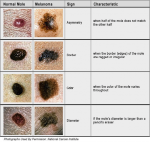 The ABCDs of checking your skin. And don't forget E - evolution. Check for any changes!