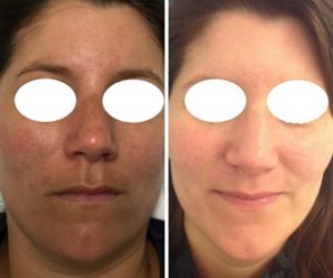 melasma prp treatment before and after photos